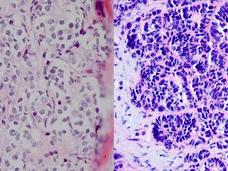 Microscopic comparison showing adenocarcinoma cells on the left and smaller, densely packed t-SCNC cells on the right.
