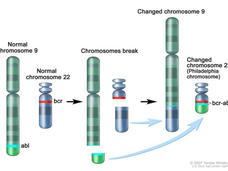 Illustration of chromosomal translocation involving chromosomes 9 and 22, showing chromosomal breaking and exchange, that results in the Philadelphia chromosome. The illustration highlights the abl gene on chromosome 9 and the bcr gene on chromosome 22, which form the bcr-abl fusion on the altered chromosome 22.