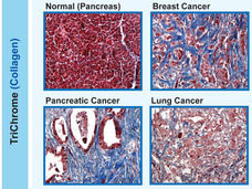 Six histological slides stained with Masson's trichrome to highlight collagen in tissues. Each slide represents a different condition: normal pancreas tissue, breast cancer, esophageal cancer, pancreatic cancer, lung cancer, and prostate cancer. The slides show varying patterns of red (indicating muscle and keratin), blue (indicating collagen), and white spaces (indicating cellular and glandular structures), offering visual insights into the structural differences between healthy and cancerous tissues.