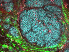 Microscopic view of a breast cancer tumor