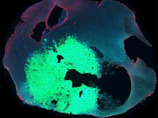 Microscopic image showing a glioma tumor in the brain tissue of a mouse.