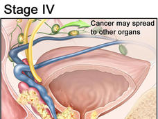 Illustration showing a close-up of the prostate and cancer spreading to other organs, with cancerous areas and lymph nodes highlighted. An arrow indicates the ability for the cancer to spread.