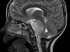 Brain scan showing a DIPG tumor in the brainstem of a child.