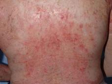 Close-up of back showing reddish, mottled skin changes characteristic of chronic graft-versus-host disease, with areas of inflammation and altered pigmentation.