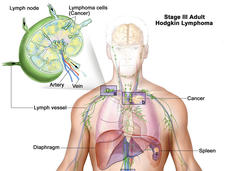 Illustration of Stage III Adult Hodgkin Lymphoma. The image shows the human body with a focus on the lymphatic system. Lymph nodes, vessels, the diaphragm, and spleen are highlighted. Cancerous lymphoma cells are present in lymph nodes above and below the diaphragm. An inset on the left provides a close-up of a lymph node, showing lymphoma cells, arteries, and veins.
