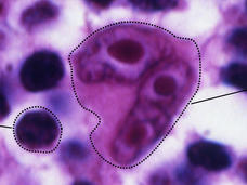 A comparison of normal lymphocytes alongside a Reed-Sternberg Cell. The lymphocyte is a dark purple circle; there are a number of these on a purple and white background. The Reed-Sternberg Cell is a medium-purple, approximately five to six times as large as the lymphocyte, and has three nuclei. 