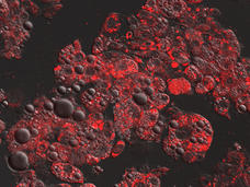 Microscopic image showing fat cells absorbing the chemotherapy drug daunorubicin, potentially reducing its effectiveness.