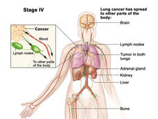 Illustration of Stage IV Lung Cancer. The image shows the human body with highlighted areas where lung cancer has spread, including the brain, lymph nodes, both lungs, adrenal gland, kidney, liver, and bone. An inset illustrates cancer cells spreading via blood and lymph nodes to other body parts. The diagram visually represents the extensive metastasis associated with Stage IV lung cancer.