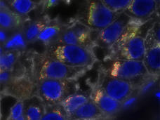 Triple-negative breast cancer cells stained to show profound molecular heterogeneity.