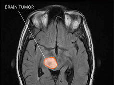 MRI of a midline glioma.