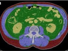 Axial CT images comparing two abdominal scans with color overlays showing skeletal muscle (purple), visceral fat (green), and subcutaneous fat (red).