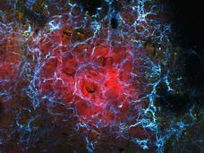 Fluorescent microscopy image showing a cancer metastasis microenvironment with red tumor cells surrounded by a network of glowing blue and yellow immune or stromal cells.