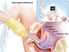 An illustrated cross-section titled “Transvaginal Ultrasound.” In the top right corner is a small illustration in which a nurse holds a transducer inside of a patient who is lying on her back, while the nurse looks at a computer screen with the ultrasound image. The larger cross section shows the transducer around surrounding anatomy, labeling the bladder, uterus, ovary, fallopian tube, and rectum. 