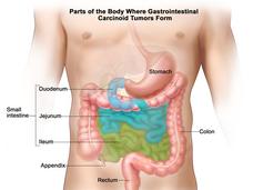 An illustration of the gastrointestinal system titled “Parts of the Body Where Gastrointestinal Carcinoid Tumors Form.” Labels highlight the stomach, colon, rectum, appendix and small intestine. The small intestine section further labels the duodenum, jejunum, and ileum.