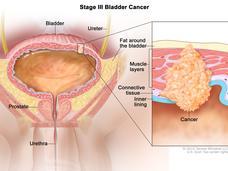 Illustration labeled “Stage III Bladder Cancer.” The main illustration labels the bladder, ureter, fat around the bladder, urethra, and prostate. A small cancer cluster inside of the muscle and fat layers of the bladder is linked to an inset illustration which labels the muscle layers, connective tissue, and inner lining of the bladder along with the actual cancer. 