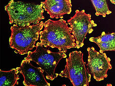 Fluorescence microscopy image of metastatic melanoma cells, with blue-stained nuclei, green-stained organelles, and red-highlighted cell membranes, illustrating cellular structure and protein distribution.