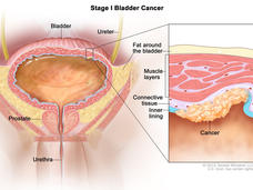 Illustration labeled “Stage I Bladder Cancer.” The main illustration labels the bladder, ureter, fat around the bladder, urethra, and prostate. A small cancer cluster inside of the muscle and fat layers of the bladder is linked to an inset illustration which labels the muscle layers, connective tissue, and inner lining of the bladder along with the actual cancer. 