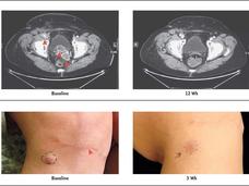 Images of a patient with stage four Merkel cell carcinoma.
