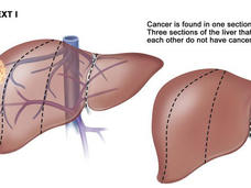 Illustration titled “Liver PRETEXT I”. Two depictions of the liver are side by side. The left labels a mass of cancer on the liver and shows veins behind the liver. The right shows the cancer mass in a different position on the liver and doesn’t show any veins. Above both illustrations, text reads “Cancer is found in one section of the liver. Three sections of the liver that are next to each other do not have cancer in them.”