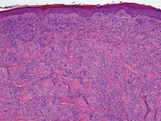 Microscopic image of desmoplastic melanoma showing spindle-shaped tumor cells embedded in dense, fibrous tissue stained in pink and purple.