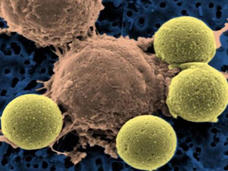 A large brown cell - a CAR T cell - surrounded by four smaller, pea-green beads. The CAR T cell has more irregularities on the surface than the beads.