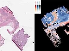 Side-by-side images of lung tissue: left shows stained slide, right shows AI-labeled cancer and normal regions.
