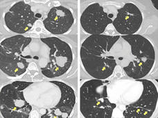 Side-by-side comparison of lung CT scans highlighting changes over time. The left column shows "Pre-Treatment" images with visible tumors indicated by yellow arrows. The right column shows scans "20 Months" post-treatment, with significant reduction in tumor size, as pointed out by the arrows.
