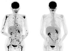 Two side-by-side PET scans of an adult body with multiple myeloma. The scans are mostly light grey; in the left scan, there are black areas spread throughout the shoulders, right arms, and throughout the lower body. On the right scan, after the BCMA-targeted CAR T cell treatment, there are approximately 80% less black areas; those that remain are mainly located in the midsection.