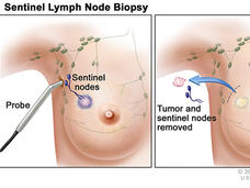 Illustration showing a three-step procedure for sentinel lymph node biopsy in breast cancer treatment. The first panel depicts an injection of a radioactive substance or dye near a tumor to identify lymph nodes. The second panel shows a probe detecting sentinel nodes. The third panel illustrates the removal of the tumor and sentinel nodes.
