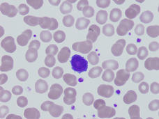Microscopic image of blood cells, featuring numerous light purple, round cells scattered across the view. Among them, a few darker purple cells stand out, highlighting different types of cells within the sample. 
