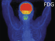 An FDG-PET scan shows a human figure from the front, highlighting areas of metabolic activity in various colors. Bright areas in red and yellow indicate higher activity, particularly in the brain, abdomen, and bladder.