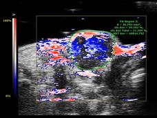 Photoacoustic ultrasound image displaying oxygen distribution (shown in red) within tumor tissue following microbubble delivery, with blue and white regions indicating other tissue characteristics and measurement data displayed on the screen.
