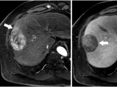 A series of three liver MRI images labeled A, B, and C showing different imaging sequences of the same liver with a mass (indicated by white arrows in each image). Each image shows the same liver lesion with different contrast and visibility depending on the MRI sequence used