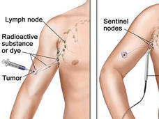 Illustration showing a three-step procedure for sentinel lymph node biopsy in skin cancer treatment. The first panel depicts an injection of a radioactive substance or dye near a tumor to identify lymph nodes. The second panel shows a probe detecting sentinel nodes. The third panel illustrates the removal of the sentinel nodes.
