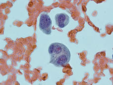 A microscopic view of smoldering myeloma. Scattered cells are colored in pink and red hues; the smoldering myeloma, which is shown as three large clumps, is colored purple.