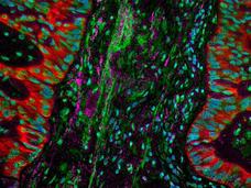 Fluorescent microscope image of a lung tumor showing cancer cells in red with green and blue highlighting other cellular structures and tissue components.