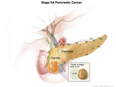 An illustration labeled “Stage IIA Pancreatic Cancer” which labels the pancreas and highlights an area on the pancreas labeled cancer. The area labeled cancer is expanded to an inset box with the title “Tumor is larger than 4 cm”, which shows an almond next to a grey circle measuring 4cm for size comparison.