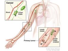 Illustration of Stage III Melanoma. The image depicts the human body with a focus on the lymphatic and circulatory systems. A primary tumor is shown on the arm, with cancer spreading to nearby lymph nodes. Insets highlight cancer involvement in lymph nodes near blood vessels as well as lymph vessel proximity to the primary tumor. Labeled features include lymph vessels, matted lymph nodes, and a primary tumor measuring 2 cm.