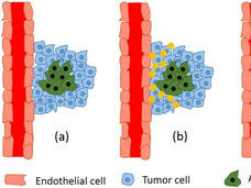 Diagram of the stages of tumor-induced angiogenesis, from angiogenic tumor clones releasing pro-angiogenic signals to new blood vessel growth toward the tumor.