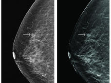 Breast nodules detected during screening by standard 2D digital mammogram (left) and tomosynthesis (right).