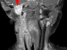 Four MRI images showing before (A, B) and after (C, D) treatment of infantile fibrosarcoma with larotrectinib, demonstrating significant tumor reduction in the neck and oral cavity areas marked with red arrows.