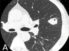A chest CT scan of a lung tumor (panel A) and a FISH test from a sample of the tumor (panel B) showing an ALK gene rearrangement (red and green spots).