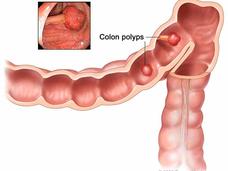 Close-up illustration of a section of the colon with two polyps, which are labeled. A small inset photograph in the top left shows a photo of a colon polyp.