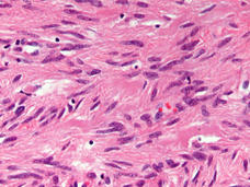A pathology slide of a gastrointestinal stromal tumor.