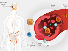 A two panel illustration. On the left, a human body with detailed illustrations of the brain and intestines. The brain has a circle labeled Metastatic Tumor, and an arrow points from the tumor to a circle in the intestine, labeled Original Tumor. On the right, a close up of a blood vessel, labeling the blood vessel, cancer cell, blood cell, and cancer cell inside the bloodstream.