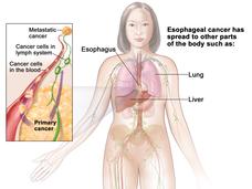 An anatomic illustration of stage IVB esophageal cancer.
