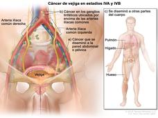 Illustration showing bladder cancer in stages IVA and IVB. On the left, a detailed view of the pelvic region highlights the bladder, iliac arteries, and lymph nodes, with labels indicating cancer spread to the abdominal or pelvic wall and lymph nodes above common iliac arteries. On the right, a human figure shows cancer spread to the lung, liver, and bone, with corresponding labels. The diagram is annotated in Spanish, providing a visual explanation of cancer metastasis.