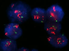 Una imagen de células de cáncer de seno con amplificación intensa de HER2.