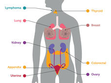 An illustration highlighting organs in which cancers were detected by an experimental blood test.