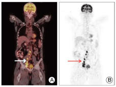 Two medical scans highlighting the body's interior. Scan A on the left is a colored PET/CT scan showing areas of active metabolism and potential abnormalities, with a white arrow indicating significant activity in the abdominal area. Scan B on the right is a grayscale image displaying similar metabolic activity, with a red arrow pointing to a focus of interest in the lower chest region. 